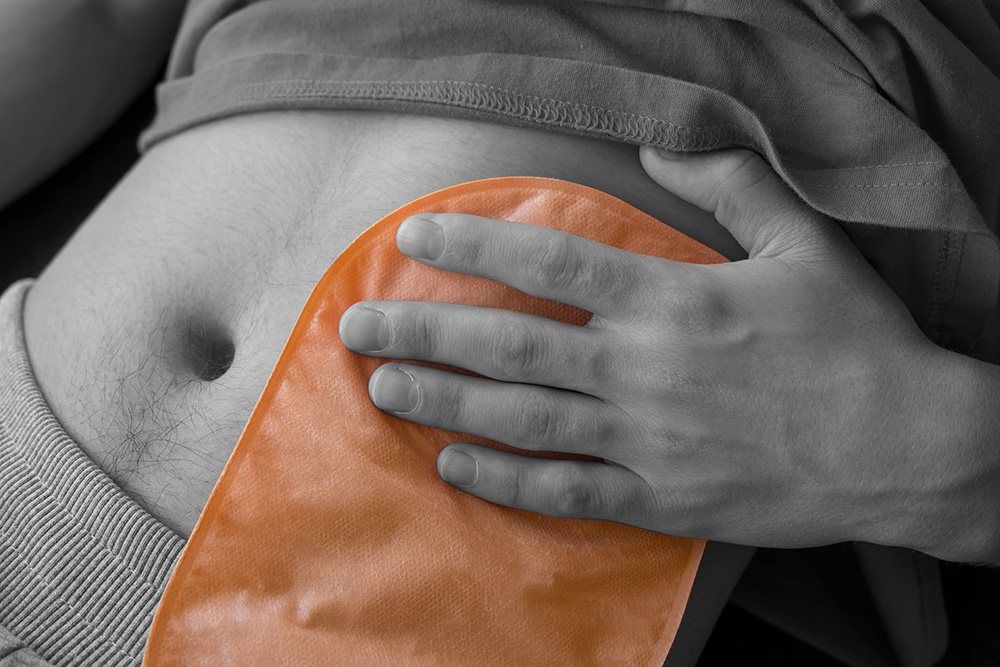 Colostomy bag: Types, uses, and living with one
